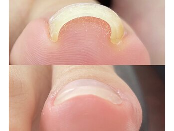 たった1回で快適に歩ける♪