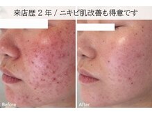 ラグランシエル(Le grand ciel)/思春期のゆらぎ肌