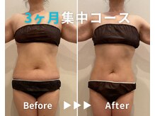 エピデリ 福岡大濠(EPI de RIZ)/【痩身/ダイエット】３ヶ月集中