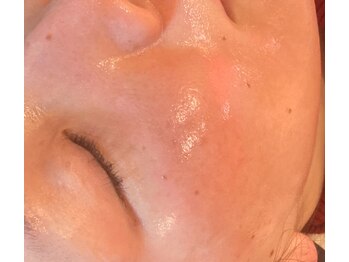 ミエリア美容鍼灸院(mielia美容鍼灸院)/肌管理、小顔は月1でok!
