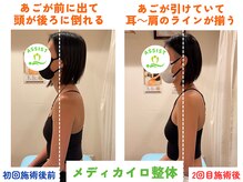 四条大宮アシスト鍼灸整骨院/全身整体ビフォーアフター