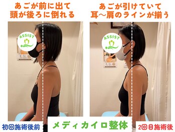 四条大宮アシスト鍼灸整骨院/全身整体ビフォーアフター