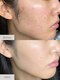 ヨサパーク ミルラ ベール(YOSA PARK Myrrh Veil)の写真/【美肌にも特化したサロン】ニキビ、毛穴、シミ、シワ、たるみ、くすみ、美白、乾燥、小顔に効きます