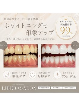 リベラサロン(LIBERA SALON)の写真/本格的ホワイトニング体験！清潔のある本来の白い歯へ理想の自分を目指そう◎
