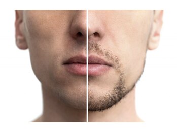 クリア(Clear)/まるごと全部☆髭脱毛1回¥6000