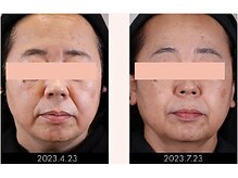 ラグラン銀座メディカルエステ 高輪ゲートウェイ店/【FACE】セルマジ・ビフォアフ