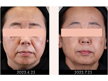 ラグラン銀座メディカルエステ 高輪ゲートウェイ店/【FACE】セルマジ・ビフォアフ