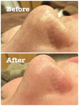 ハリキュア(Hari-Cure)/毛穴の汚れをゴッソリ除去