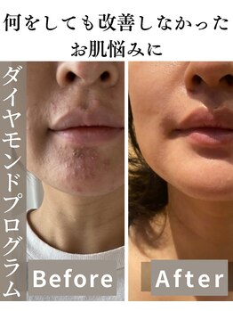 癒える(ielu)/ダイヤモンドピール★