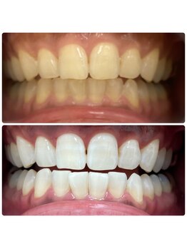 エクシアホワイトニング 日本橋店/タバコのヤニでも