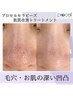 【ご新規様】50,000円→41,000円【毛穴・凹凸】肌質改善トリートメント
