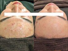 ボディーワークスナビ(Body Works Navi)/【ハーブピーリング】施術例