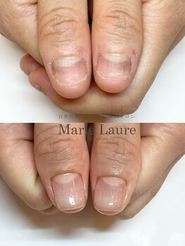 マリーロール 淀屋橋本店(Marie Laure)/自爪育成/深爪矯正/ネイルケア
