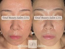 エル 麻布十番/たるみ/小顔/毛穴/フェイシャル