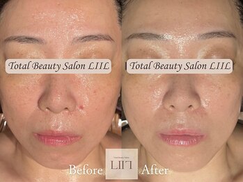 エル 麻布十番/たるみ/小顔/毛穴/フェイシャル