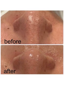 ユー(U)/毛穴の徹底洗浄！