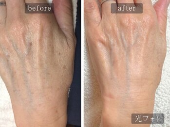 アムールサロン(Amour salon)/光フェイシャルでシミケア/新宿