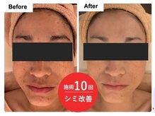 トリアングル(TLIENGLE)/最新ポレーションビフォアフ