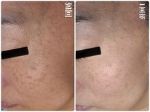 キレイ(KIREI)/before　＆　after