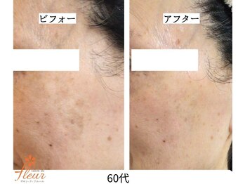 サロンドフルール/リセラ「ADS」肌改善プログラム