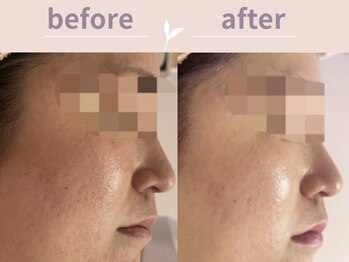 アール(R)/美しいお肌へ！