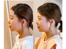 小顔22 ボルティ 本店(Bolty)/Before→After（2回）