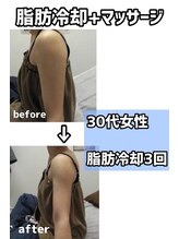 メゾンドロイヤル(Maison_de_ROYAL)/冷却カップ。脂肪細胞アプローチ