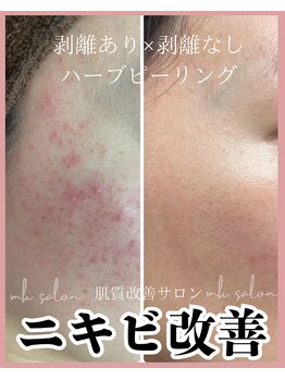 エムケーサロン(MK salon)/ニキビケア(ハーブピーリング)