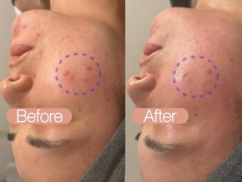 クレヴィア バイ サイバーエステ(CREBIA)/毛穴/ニキビ【ビオフィート】