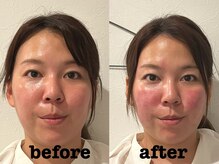 ソラナ(Solana)/美容鍼（百華鍼）