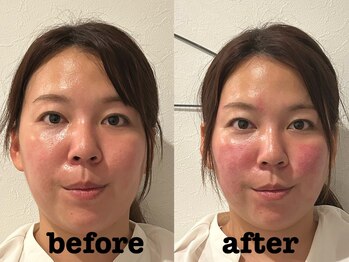 ソラナ(Solana)/美容鍼（百華鍼）