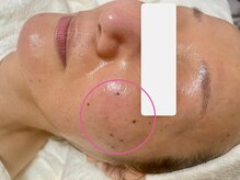 ボディメイキング キキ(Bodymaking KIKI)/ピンポイントでシミケア