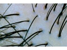 女性のための育毛促進・頭皮ケア専門サロン　イーズ／リバイタ　ららぽーと横浜/case3 20代女性　before