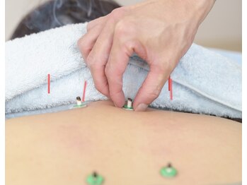 小林はり灸/はり灸