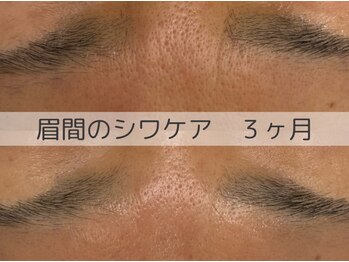 ベアール(beal)/効果No.1たるみシワケア3ヶ月