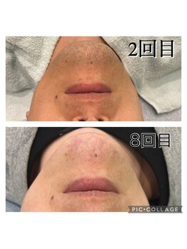 レイモード(Ray mode)/髭脱毛爆抜け8回目