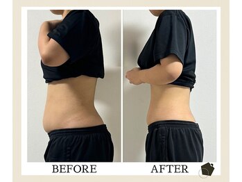 サンク(Cinq)/反り腰によるぽっこりお腹を改善