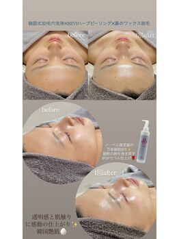 クレヴィー(Creviy)/韓国式3D毛穴洗浄+ハーブ+脱毛