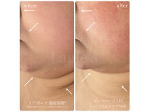 ラウレア(Laule'a)の雰囲気（脂肪分解で美肌小顔に♪たるみケア◎部分/全身ダイエットも！）