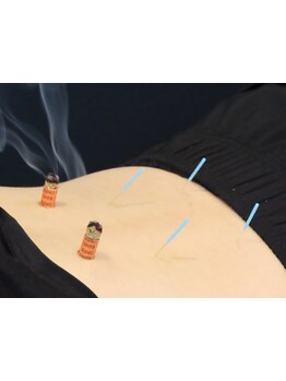 鍼灸施術を受けたい