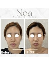 ノア 新宿(Noa)/小顔矯正＋エステポテンツァ3回