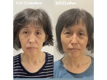 ソマティックチェンジ 麻布十番店(Somatic Change)/セルラム施術前後