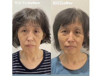ソマティックチェンジ 麻布十番店(Somatic Change)/セルラム施術前後