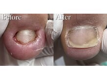 巻き爪補正店 越谷店/陥入爪補正