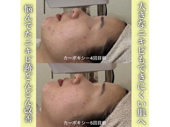 ハニエル(Haniel)/カーボキシー症例