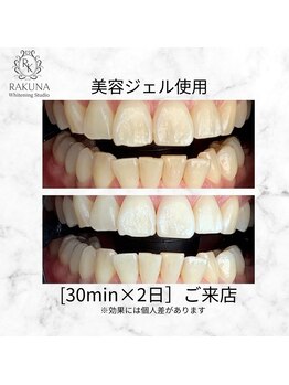 ラクナ ホワイトニング(RAKUNA)/美容ホワイトニング初回体験