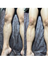 カナウ(KANAU)/足脱毛（20代前半男性）