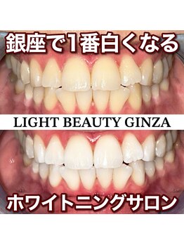 ライトビューティー 銀座店(LightBeauty)/東銀座 ホワイトニング 症例写真