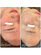 ラディエンス 多治見店/ヒト幹細胞毛穴エステ