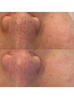 ノイ(Noi.)/Before-After